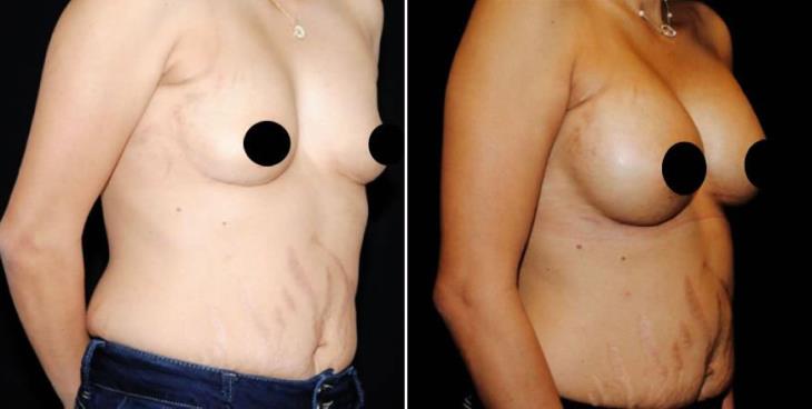 Before & After Breast Implants ¾ View