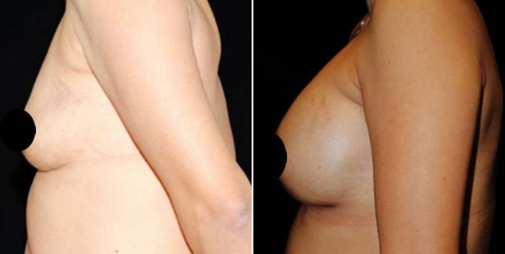 Before & After Breast Implants Side View