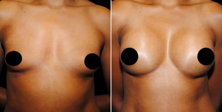 Results Of Breast Augmentation In Atlanta