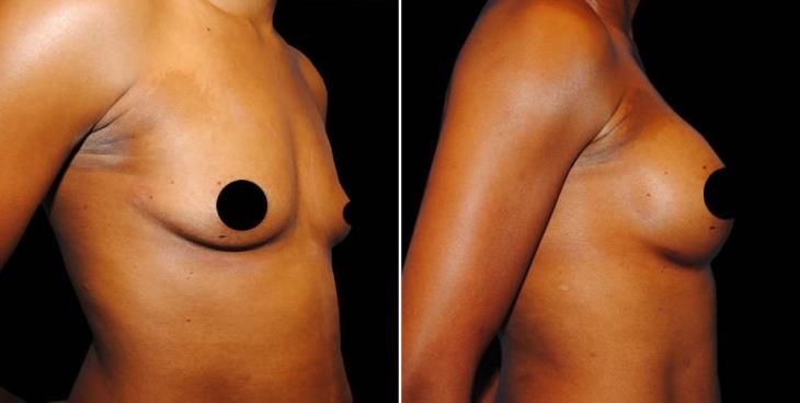 Results Of Breast Augmentation In Atlanta Side View