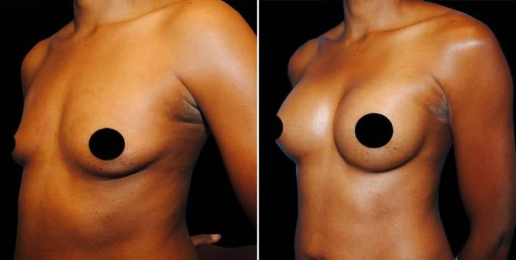 Results Of Breast Augmentation In Atlanta ¾ View