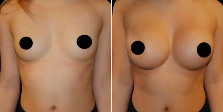 Before & After Breast Implants Atlanta