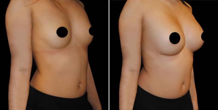 Before & After Breast Implants Atlanta ¾ View