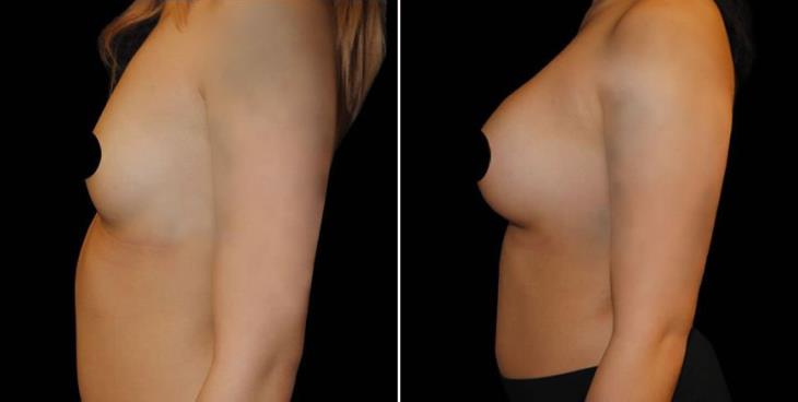 Before & After Breast Implants Atlanta Side View