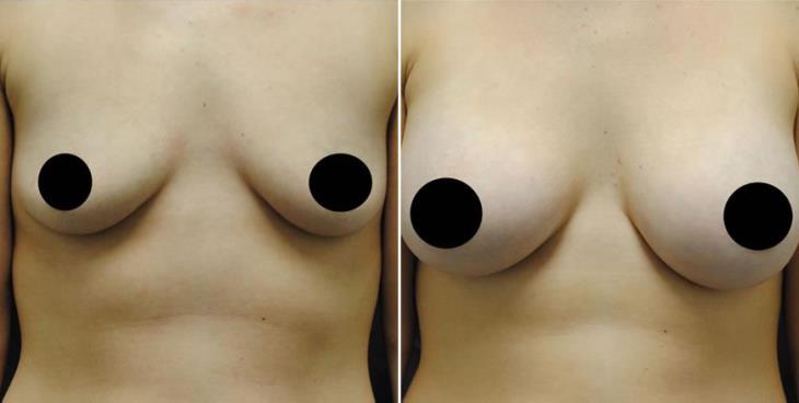 Before And After Breast Implants Atlanta