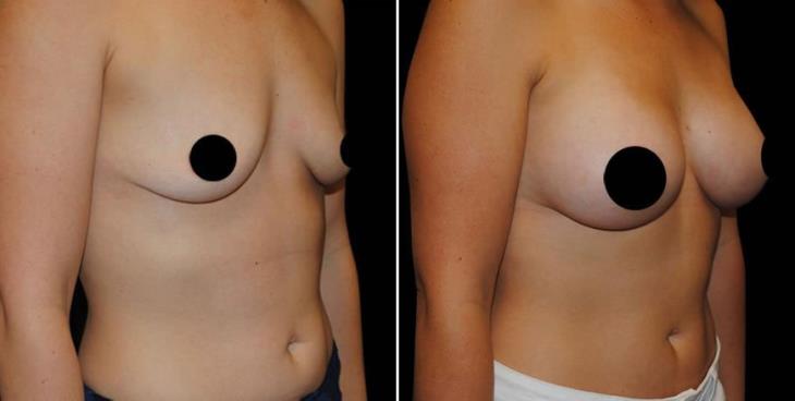 Before And After Breast Implants Atlanta ¾ View