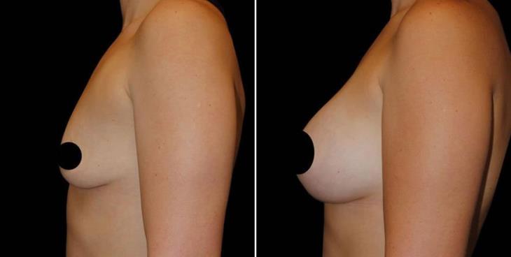 Before And After Breast Implants Atlanta Side View
