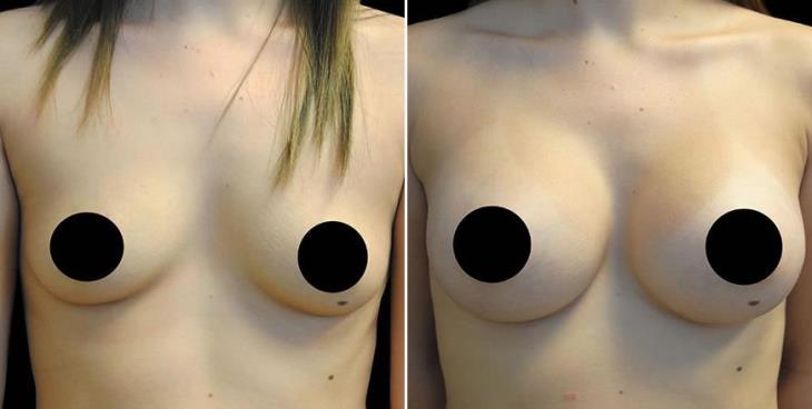 Atlanta Breast Implants Before & After