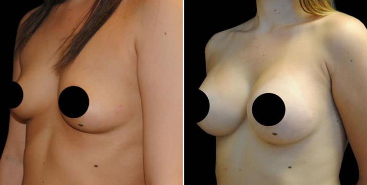 Atlanta Breast Implants Before & After ¾ View