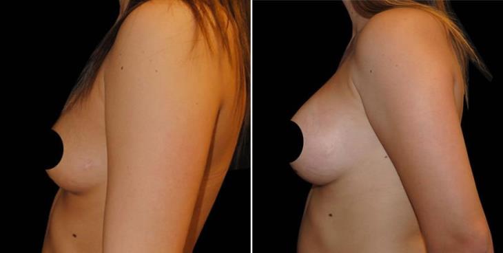 Atlanta Breast Implants Before & After Side View