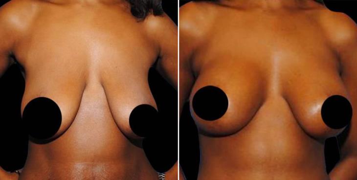 Breast Lift Before And After