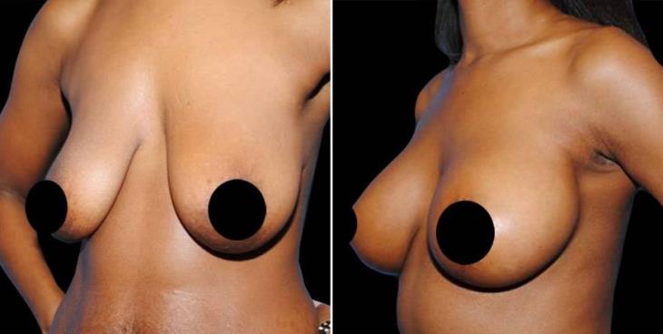 Breast Lift Before And After Side View