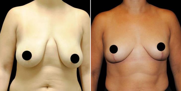 Before And After Breast Lift