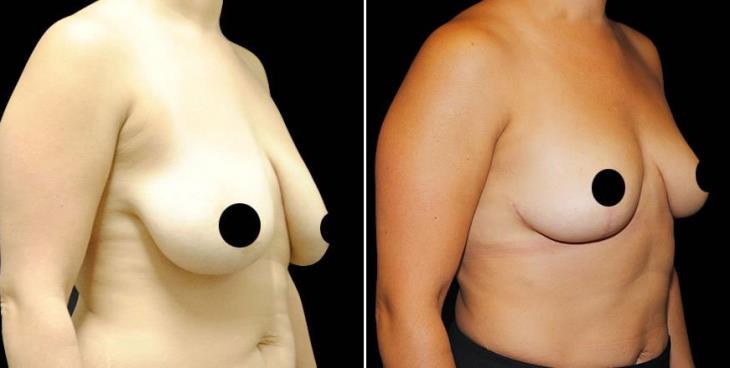 Before And After Breast Lift Side View