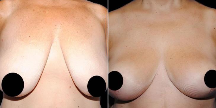 Before & After Breast Lift