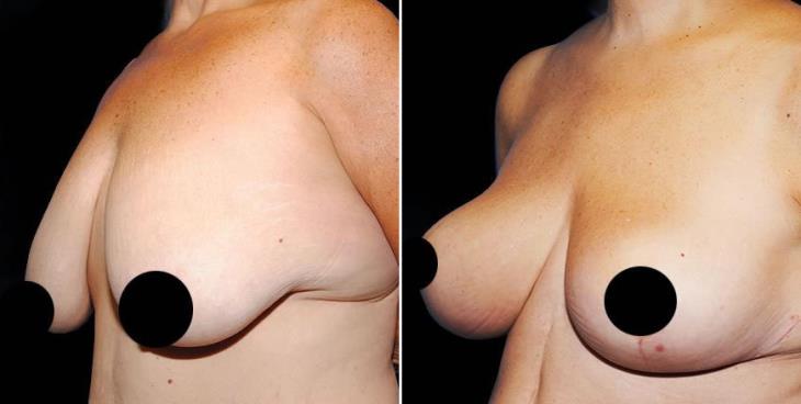 Before & After Breast Lift Side View