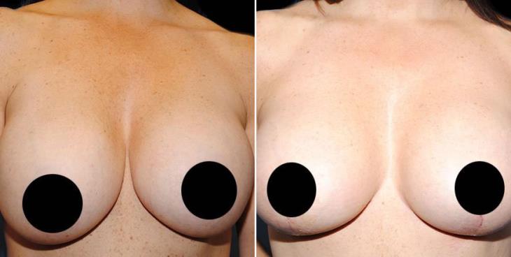 Breast Lift Before & After