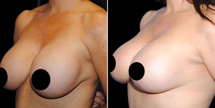 Breast Lift Before & After Side View