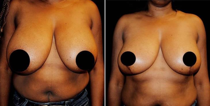 Atlanta Breast Lift Results