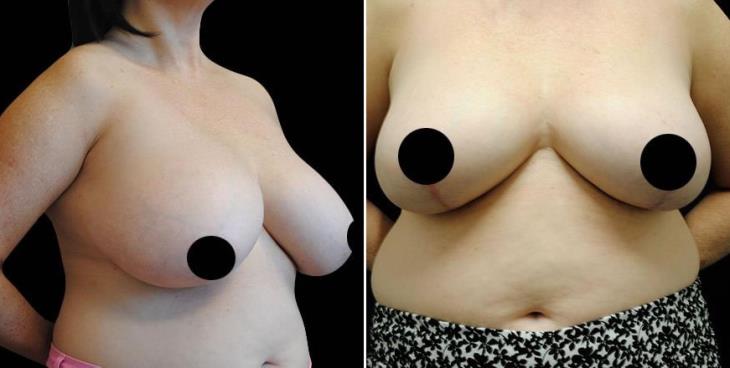 Before And After Breast Lift Atlanta Side View