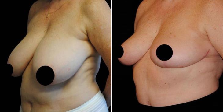 Atlanta Breast Lift Before And After Side View