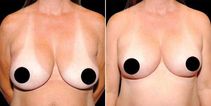Before & After Breast Lift Atlanta