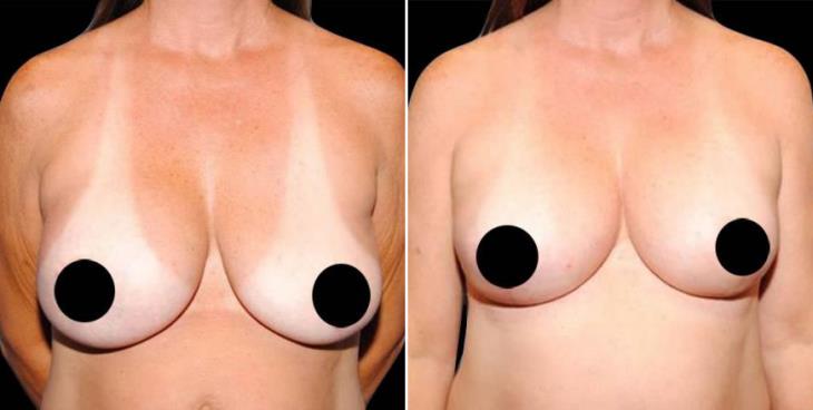 Before & After Breast Lift Atlanta