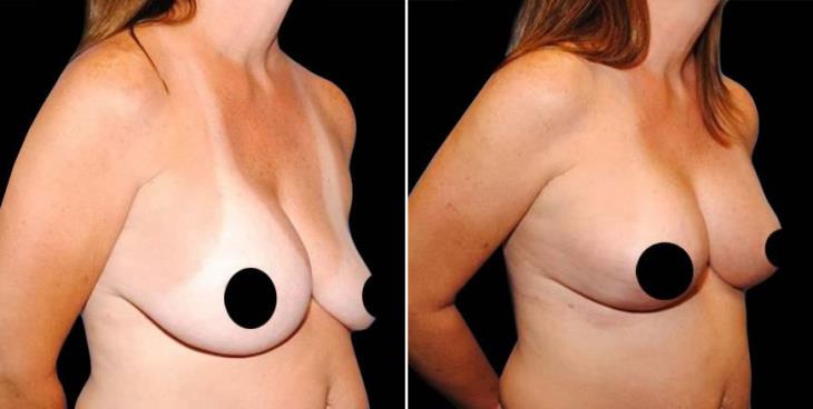 Before & After Breast Lift Atlanta Side View