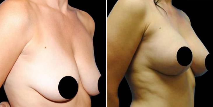 Atlanta Breast Lift Before & After Side View