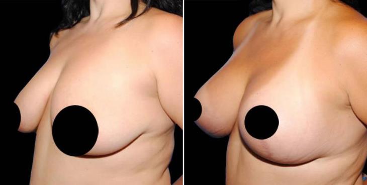 Breast Lift Atlanta Georgia 