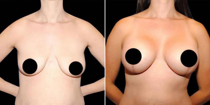 Atlanta Georgia Breast Lift