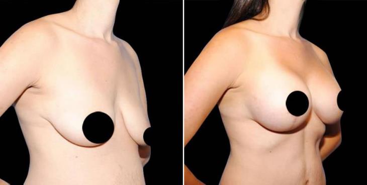 Results Of Breast Lift Surgery In Marietta