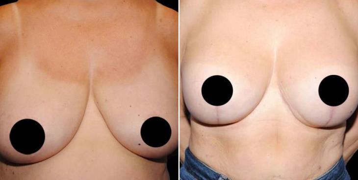 Mastopexy Before And After