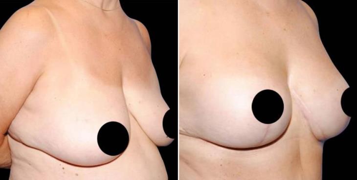 Atlanta Georgia Breast Lift Side View