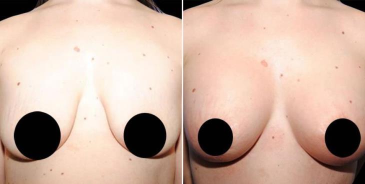 Before And After Mastopexy