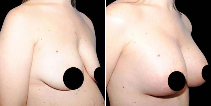 Before And After Mastopexy Side View