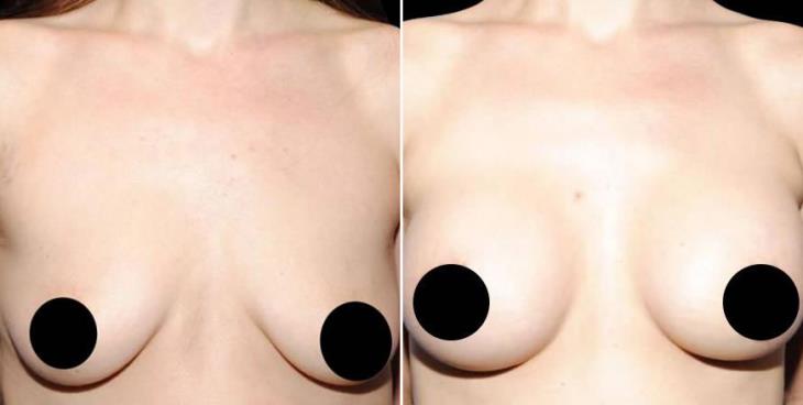 Mastopexy Before & After