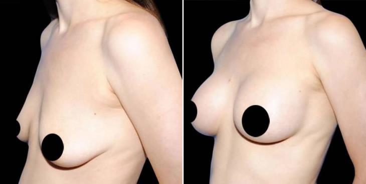 Mastopexy Before & After Side View