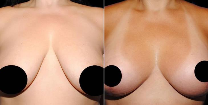 Before & After Mastopexy