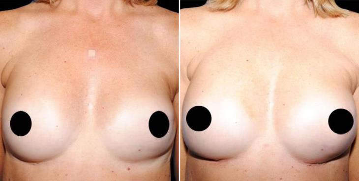 Breast Reconstruction Results