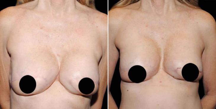 Results Of Breast Reconstruction