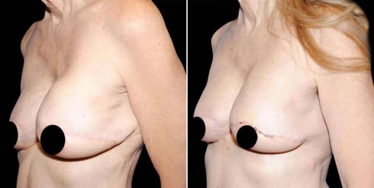 Results Of Breast Reconstruction Side View