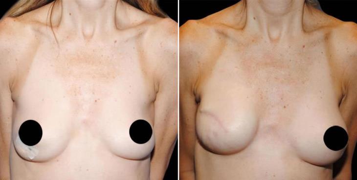 Breast Reconstruction Results Atlanta
