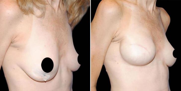 Breast Reconstruction Results Atlanta Side View