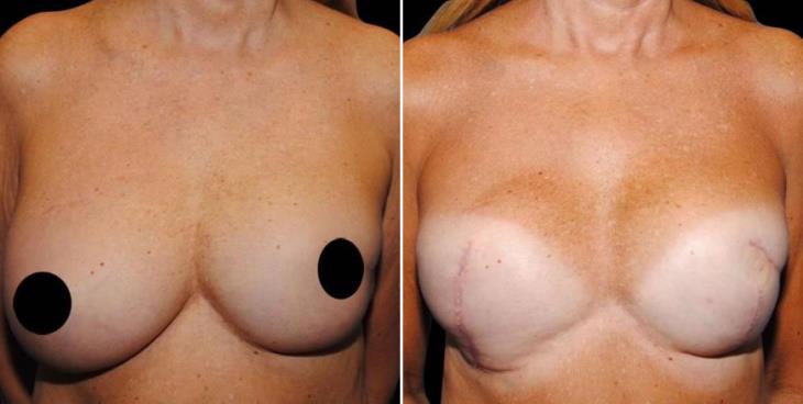Results Of Breast Reconstruction Atlanta