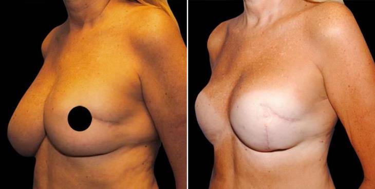 Results Of Breast Reconstruction Atlanta Side View