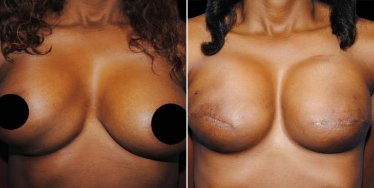 Atlanta Breast Reconstruction Results