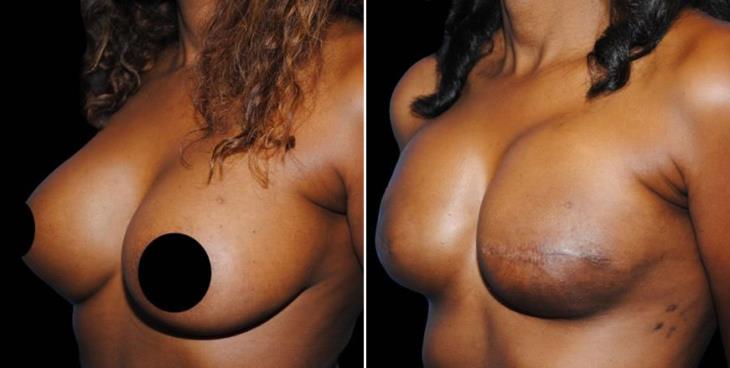 Atlanta Breast Reconstruction Results Side View