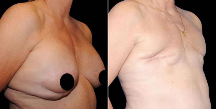 Before And After Breast Reconstruction Side View