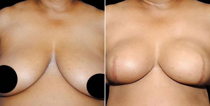 Breast Reconstruction Before & After